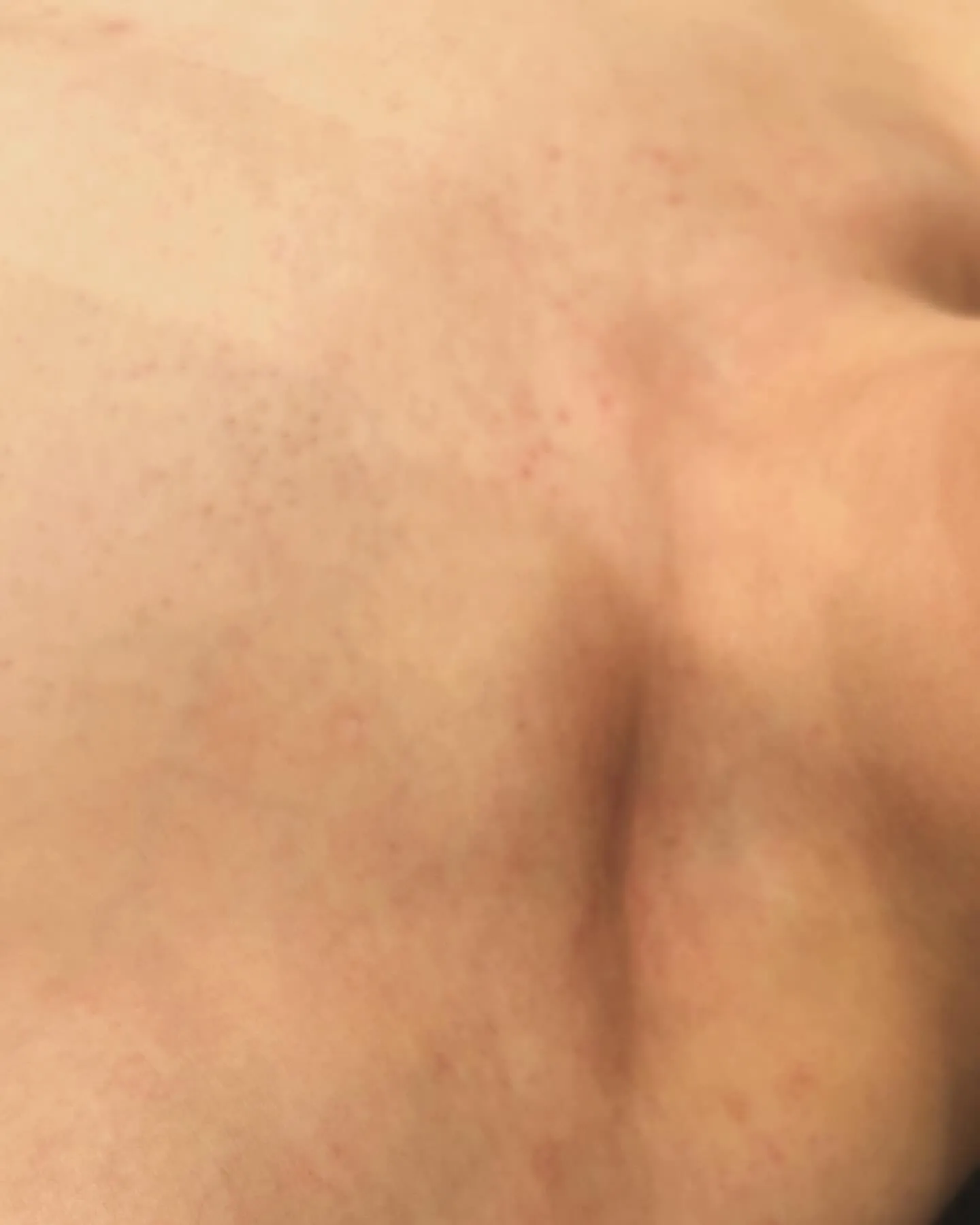 プラズマ照射で劇的にアトピー性皮膚炎が改善したお客さま | ブログ | 三重県津市の脱毛ならRencontre